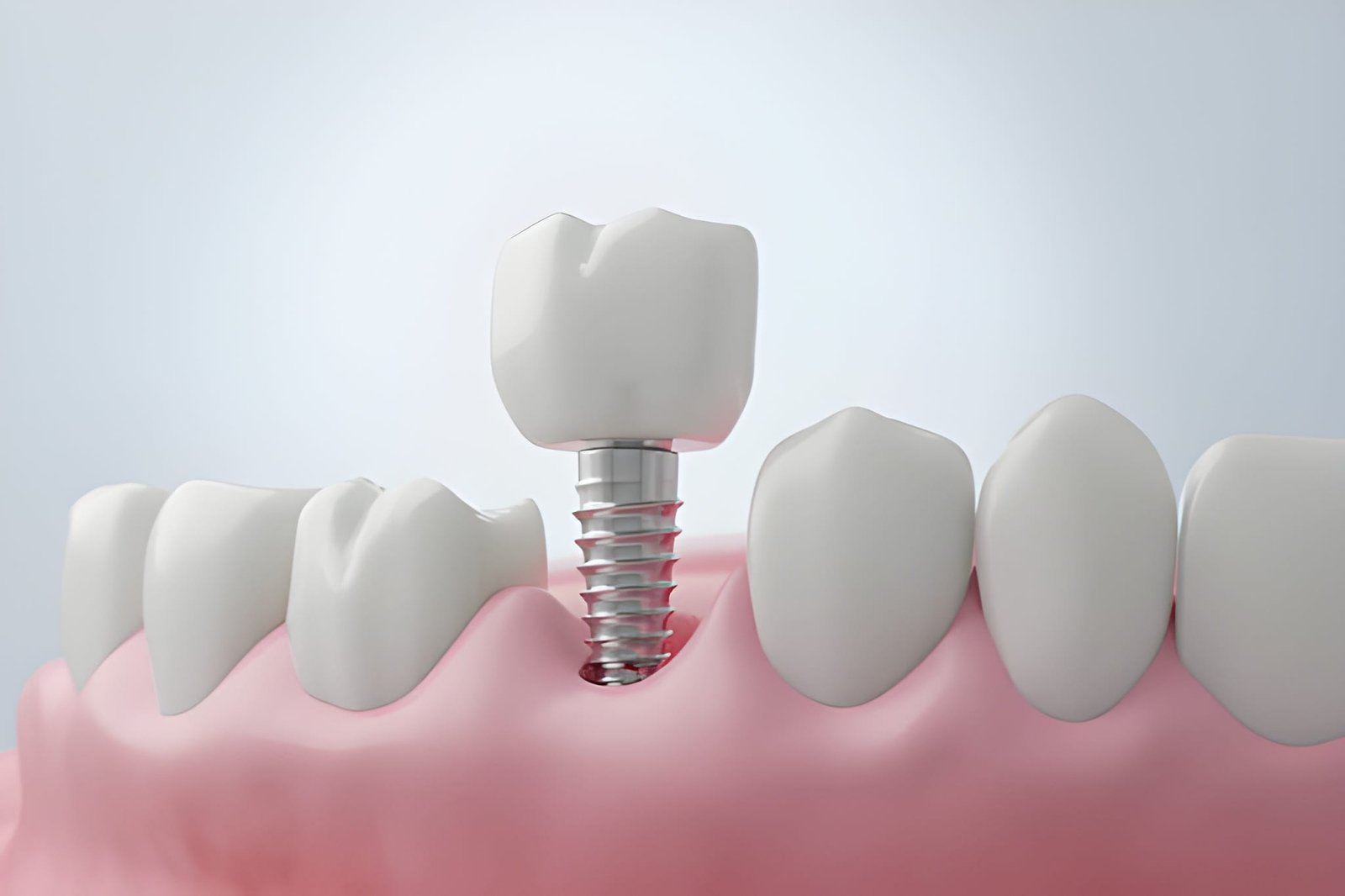 Dental Implants