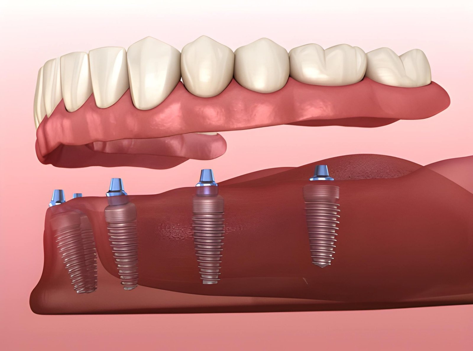 Single Implant vs All-on-4: Which Is Right for Your Situation?