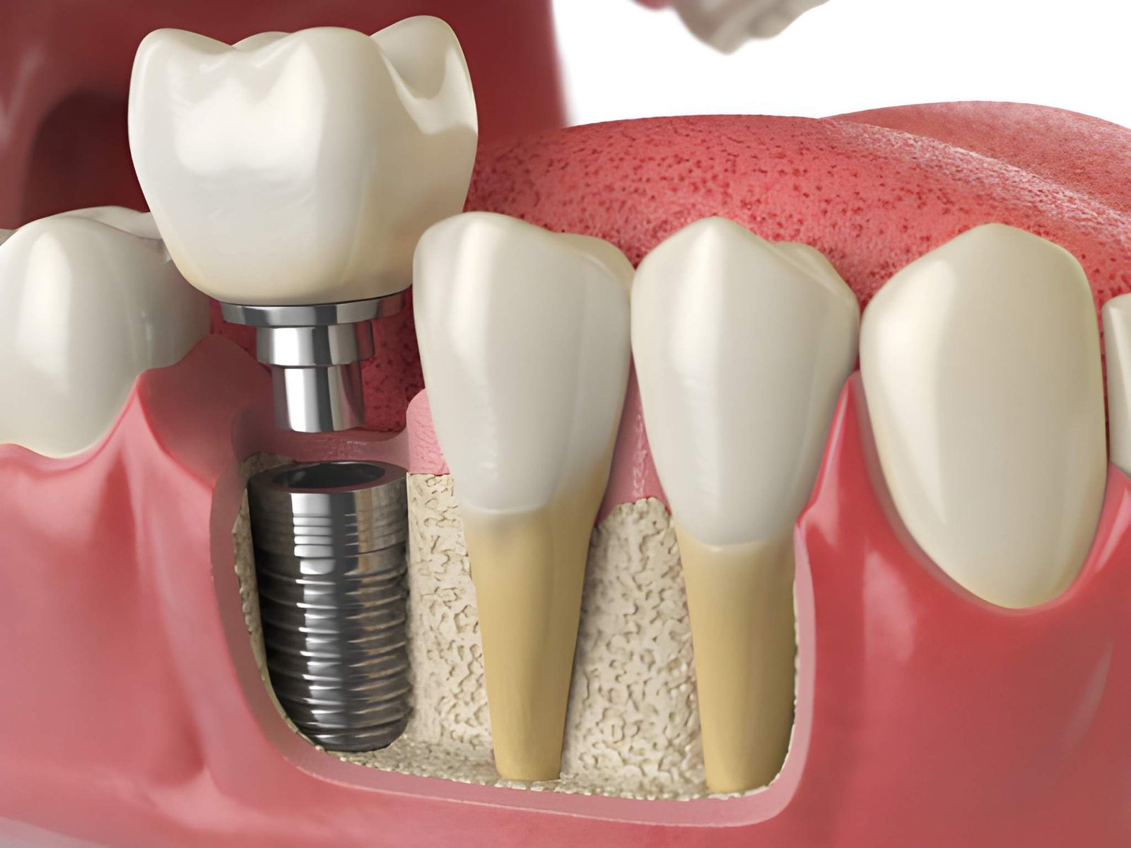 not enough bone for dental implants